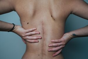 A woman standing upright with her hands on her back, indicating recovery from a back surgery
